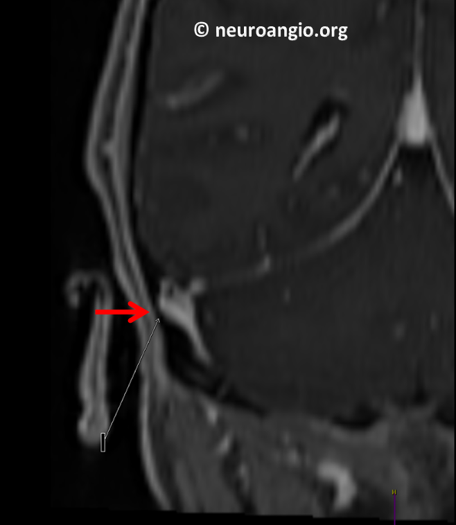 Pulsatile Tinnitus Venous Sinus Diverticulum Stenting